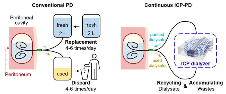 ▲ Figure 1. (Left) Conventional peritoneal dialysis method (Right) Overview of peritoneal dialysis with continuous dialysis fluid regeneration using ion concentration polarization